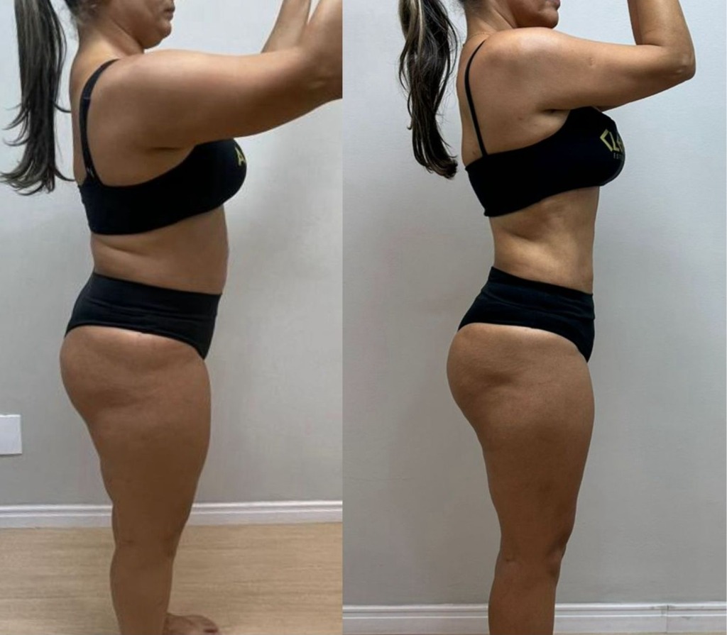 Resultado Antes e Depois