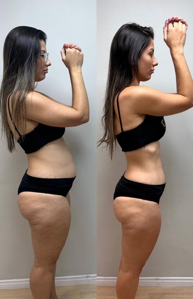Resultado Antes e Depois