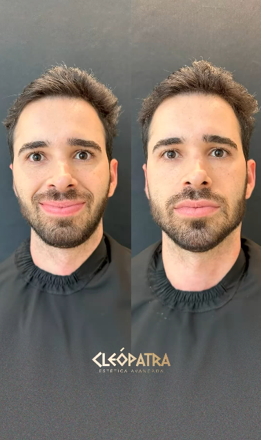 Resultado Antes e Depois
