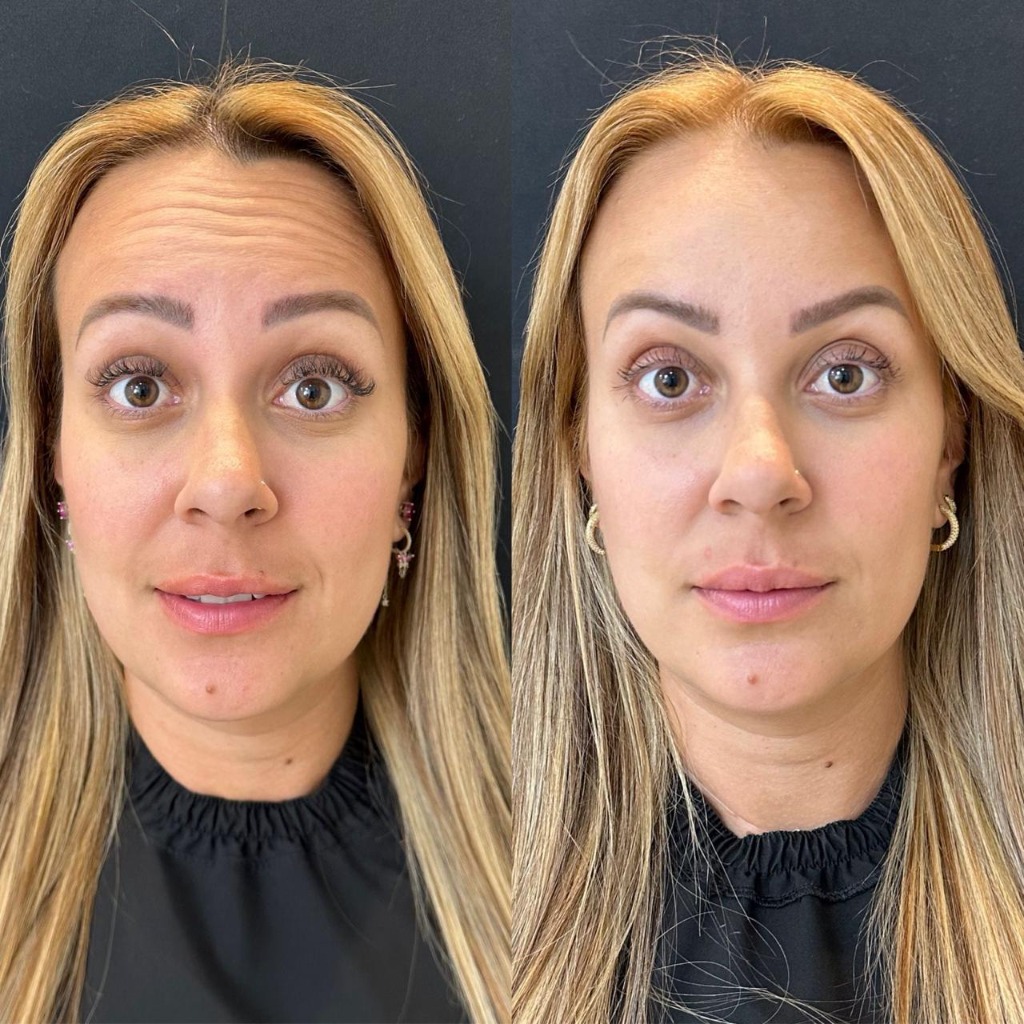 Resultado Antes e Depois