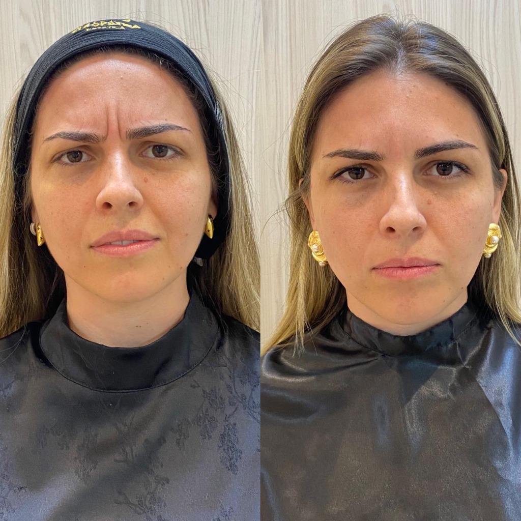 Resultado Antes e Depois